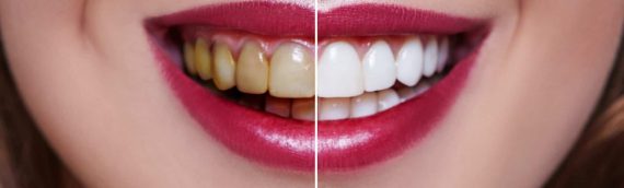 What is Teeth Whitening?