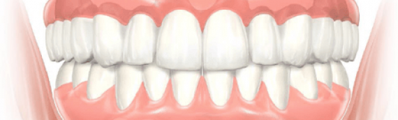 What is an All on 4 Dental Implant