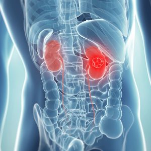What is Kidney cancer